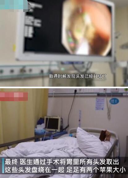【触目惊心】女童吃头发2年塞满胃部 何种压力致使10岁女孩吃了2年头发?