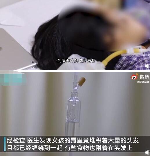 【触目惊心】女童吃头发2年塞满胃部 何种压力致使10岁女孩吃了2年头发?