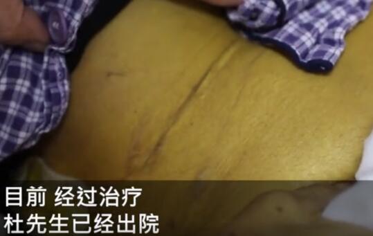 男子抽烟喝酒30年全身变黄似铜人  网友：自己也抽烟喝酒，想想太可怕了