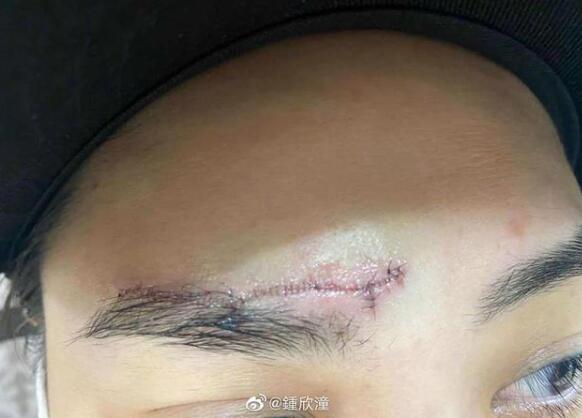 【触目惊心】阿娇晒伤口照片 在酒店房间究竟发生了什么? 