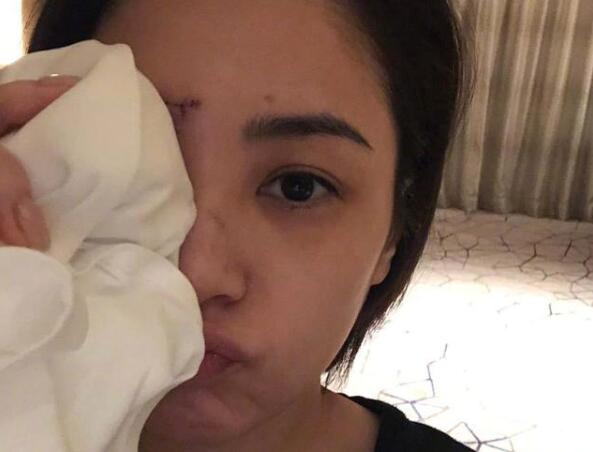 【触目惊心】阿娇晒伤口照片 在酒店房间究竟发生了什么? 