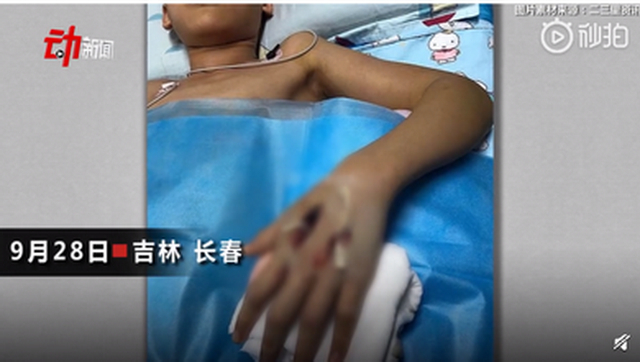 谁来担责?13岁男孩网购宠物蛇被咬进ICU 治疗过程一波三折
