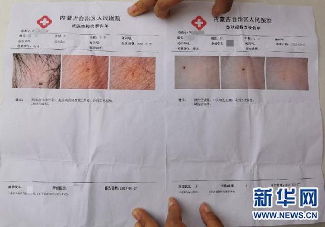 幼儿园孩子身上现针眼 警方通报来了，都说了什么？