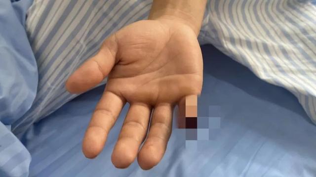 云南辅警抓偷渡蛇头被咬断手指,到底发生了什么?