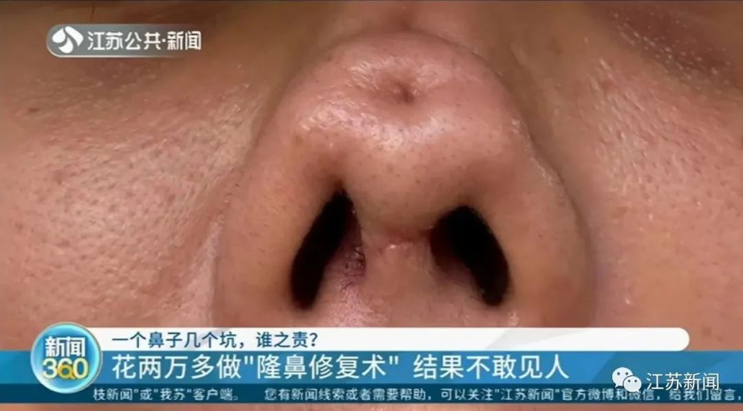 女子整形完鼻子变4个洞 医院:抽烟导致鼻子感染