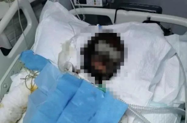 女网红被前夫泼汽油烧到焦黑 竟还有人为犯罪者开脱?