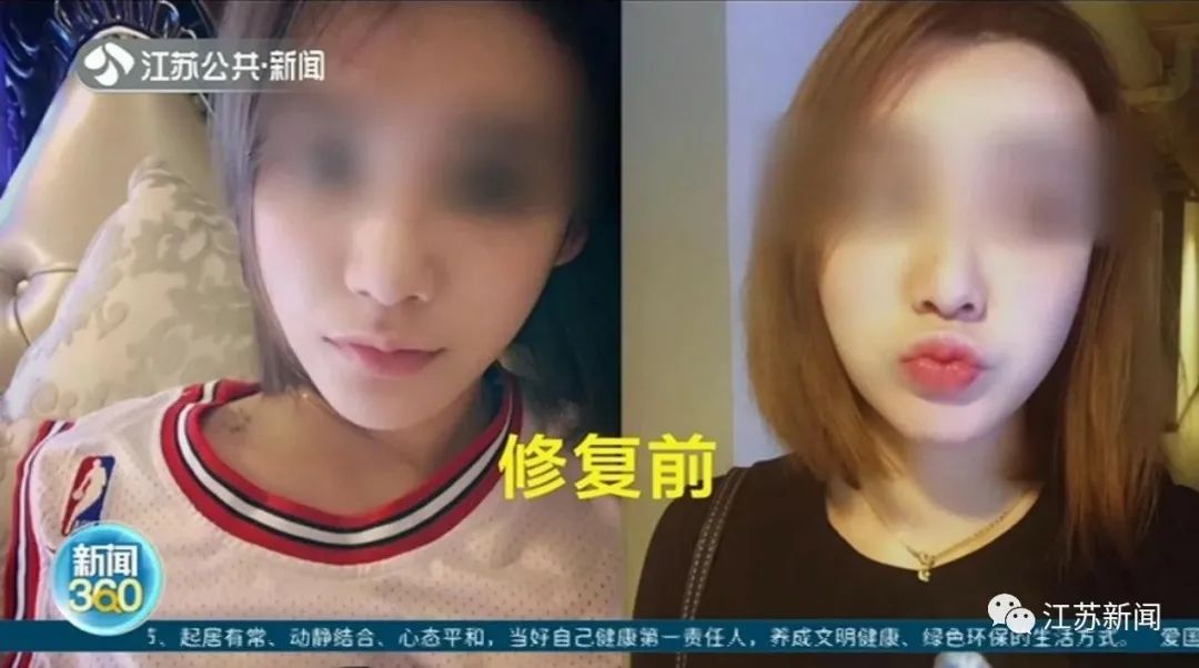女子整形完鼻子变4个洞 医院:抽烟导致鼻子感染