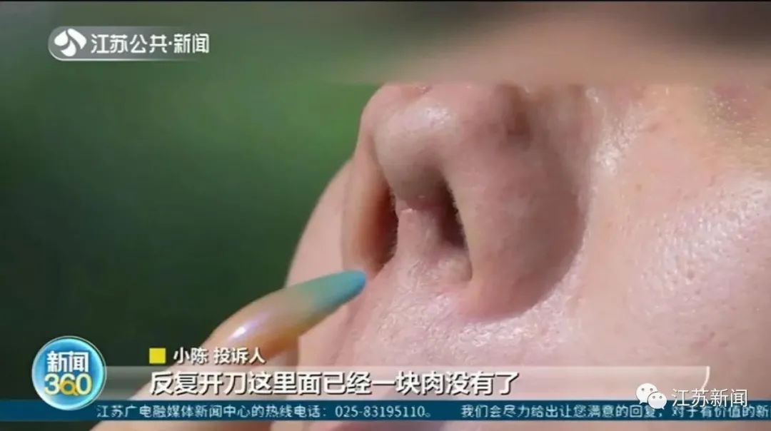 女子整形完鼻子变4个洞 医院:抽烟导致鼻子感染